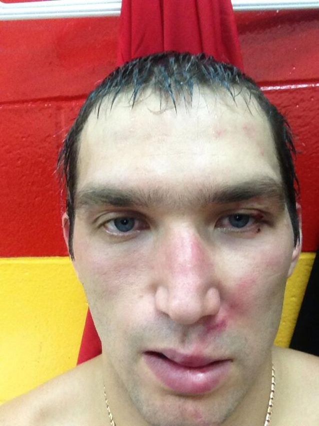 Овечкину подпортили внешность клюшкой